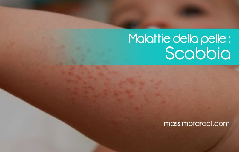 i sintomi della scabbia |come evitare il contagio della scabbia