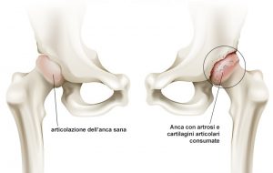 dolori articolari articolazione anca