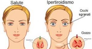Ipertiroidismo