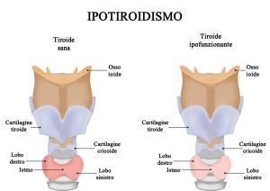 Ipotiroidismo