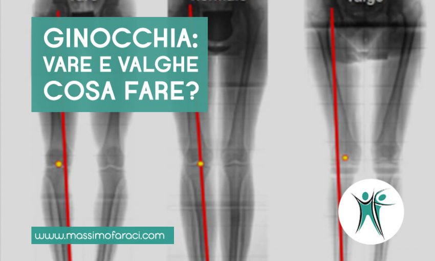 Ginocchia storte