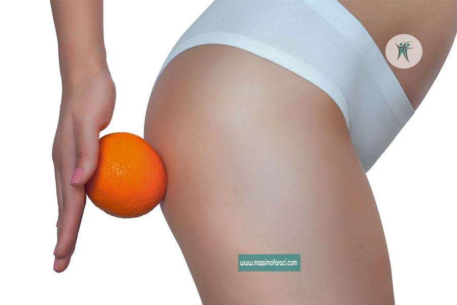 Cellulite o ritenzione idrica